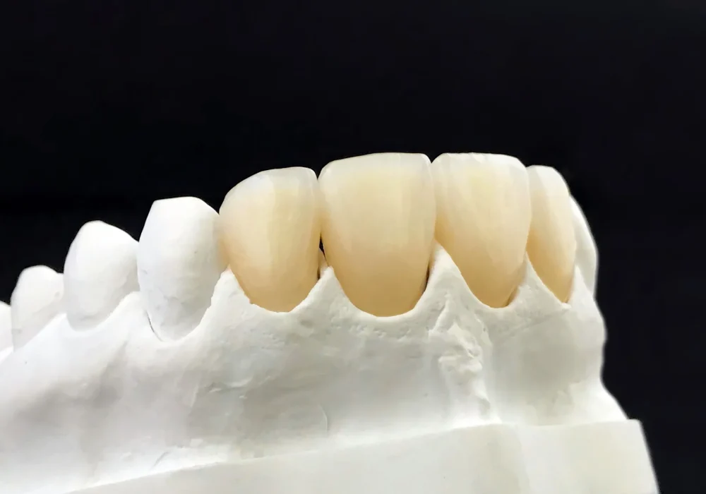 dental-zirconia-crowns-in-the-plaster-model